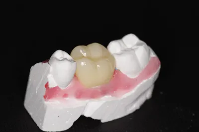 Циркониевые коронки на зубы: установка, цены в Тамбове | Стоматологическая  клиника АЛМАZstom