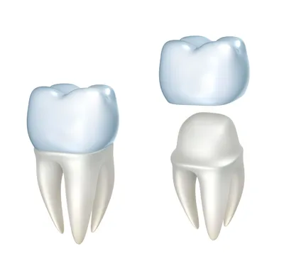 Зубные коронки - виды, какие лучше, показания, этапы установки