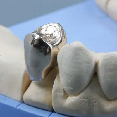 Металлические зубные протезы в СПб