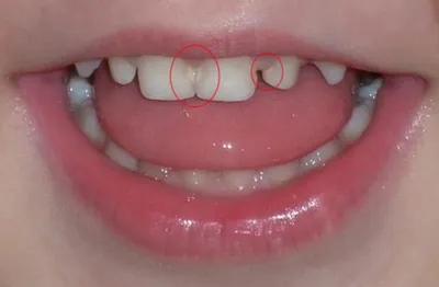 Лечение кариеса молочных зубов у детей до и после 2 лет по доступной цене в  стоматологической клинике Vitart