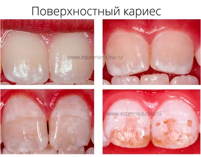 Начальный кариес: лечение, фото, диагностика | Интернет-журнал  Estetmedicina.ru