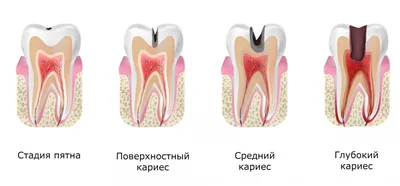 Лечение кариеса зубов в Краснодаре по выгодным ценам