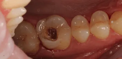 Стоматология \"Жемчуг\" | Кариес зубов