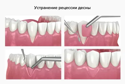 Пластика десны в Москве — цена в Manashirov Dental Clinic