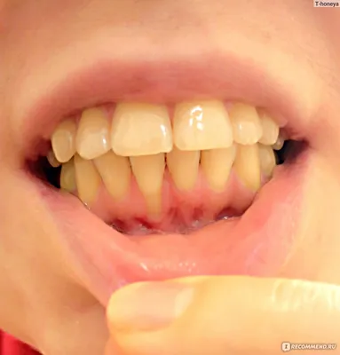 Пластика десны - «Пластика десны (гингивопластика) - отзыв о закрытии  рецессии десны при оголившемся корне зуба» | отзывы