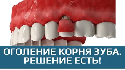 Пластика слизистой полости рта в Днепре - Дентал Евро