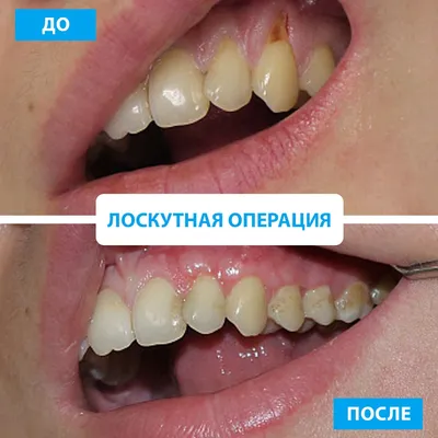 Лоскутная операция в области 1 зуба 💎 от 4200 рублей в клинике Денталюкс в  Рязани