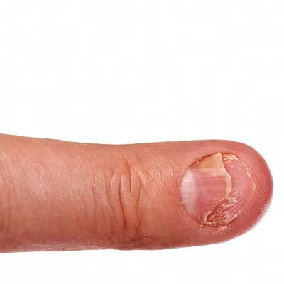 Трещины на ногтях: причины, виды и лечение | Блог маникюрного салона в  Москве
