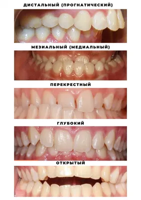 Виды зубов фото