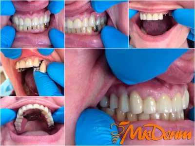 Протезирование зубов - Стоматологическая Клиника МК ДЕНТ