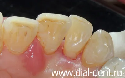 Удаление зубного налета и лечение кариеса зубов