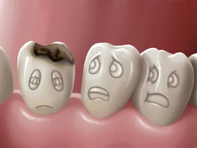 Кариес зубов: симптомы, диагностика и лечение заболевания | БРЕКЕТ Клаб