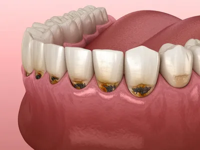 Лечение кариеса зубов в стоматологии «КАС+»
