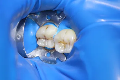 Лечение кариеса 36, 37 зуба в Дентал Форте