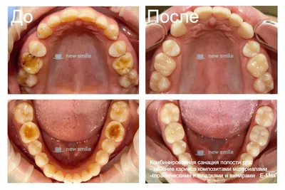 Лечение кариеса в городе Раменское цена от 1600 руб - «New Smile»