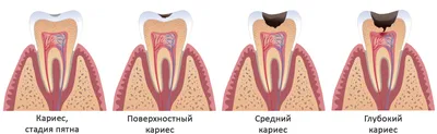 Средний кариес: симптомы и методы лечения постоянных зубов