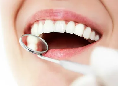 Лечение кариеса зубов в Киеве | Стоматология Prioritet