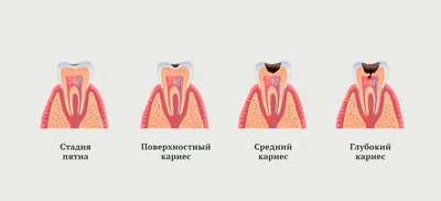 Лечение кариеса зубов в Минске — стоматология «Мона Лиза»