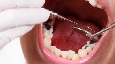 Лечение кариеса зубов в Киеве ᐉ Стоматологическая Клиника Dental Art