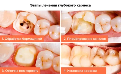 Глубокий кариес – особенности лечения и возможные осложнения