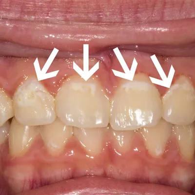 Терапевтическая стоматология – лечение различных видов кариеса, заболеваний  десен
