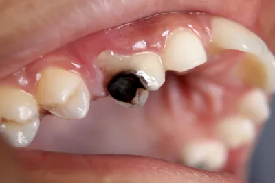 Средний кариес зубов - диагностика и лечение