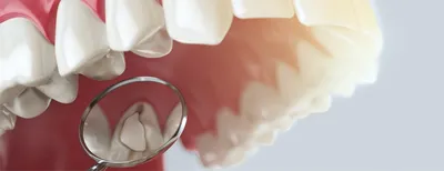 Вторичный кариес. Враг, которого сложно заметить Стоматология Dental Way в  Москве и Московской области | Dental Way