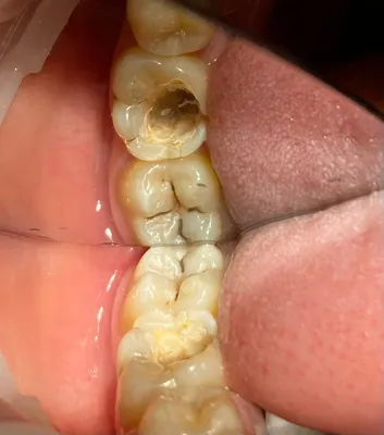 Средний кариес 47 зуба, выпадение пломбы 46 зуб | Фото примеров работ