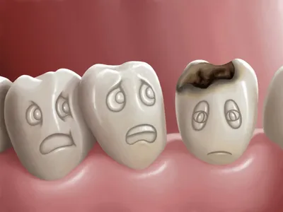 Лечение кариеса зубов, любая сложность кариеса