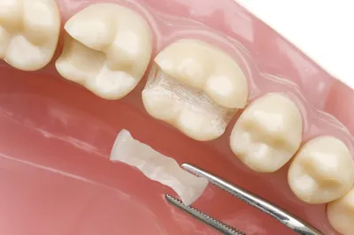 Зубная пломба на самый дальний зуб