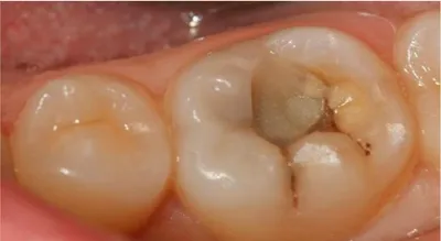 Лечение фиссурного кариеса зубов под микроскопом