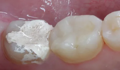 Фотополимерная пломба поверхностный кариес (молочный зуб) | Serdolik-Dent