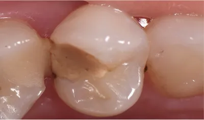 Ошибки в стоматологии: скрытый кариес под пломбой