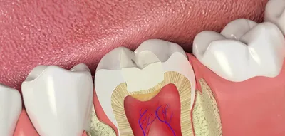 Что делать если болит зуб под пломбой — черные точки на зубе что это?