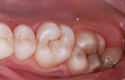Что такое кариес на самом деле | ГАУЗ «Краевая стоматологическая  поликлиника»