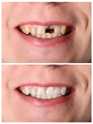 Установка коронок на передние зубы | Цена восстановления передних зубов от  12000руб в стоматологии Доктор Бон