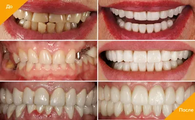 Металлокерамика на передние зубы до и после фото