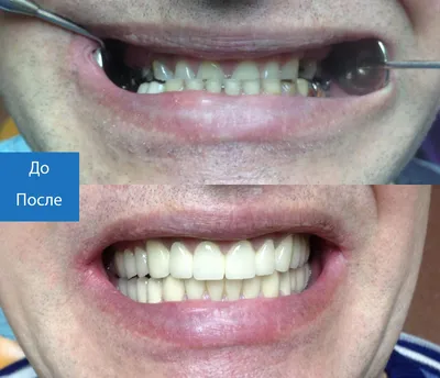 Протезирование зубов металлокерамикой по доступной цене в Москве