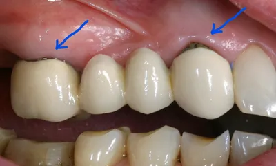Нужно ли менять зубные коронки, как часто следует это делать?