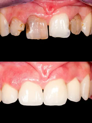 Установка коронок на передние зубы | Цена восстановления передних зубов от  12000руб в стоматологии Доктор Бон