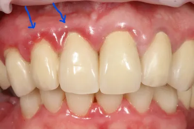 Нужно ли менять зубные коронки, как часто следует это делать?