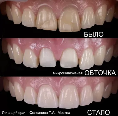 Какими бывают керамические коронки на зубы | Альянс бьюти-ортопедов, Москва