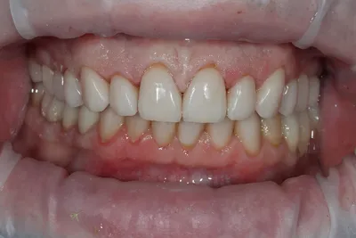 Металлокерамические коронки на зубы - что это такое: фото металлокерамики,  плюсы и минусы зубных протезов, как выглядят, технология протезирования,  преимущества и недостатки, из чего их делают, толщина и этапы установки