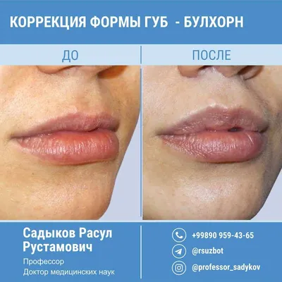 Булхорн - изменение формы губ