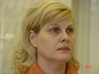 Хирургический SMAS-лифтинг - круговая подтяжка лица в Москве