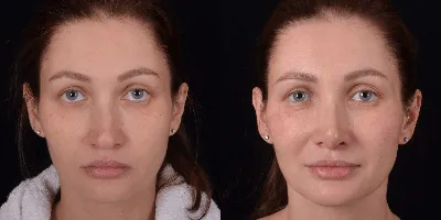 Ринопластика фото до и после, пластика носа результат операции