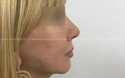 Ринопластика повторная. Исправление кончика носа | Ринопластика Фото до и  после | Клиника пластической хирургии «Основа»
