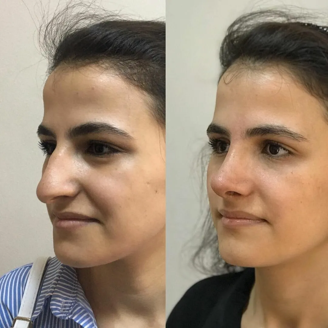 Фото ринопластики до и после нос