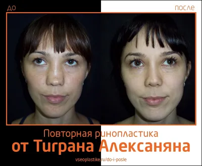 Тигран Алексанян. Фото до и после повторной ринопластики