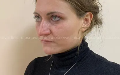 Фото до и после операции по повторной ринопластике носа в Москве | Клиника  пластической хирургии «Основа»